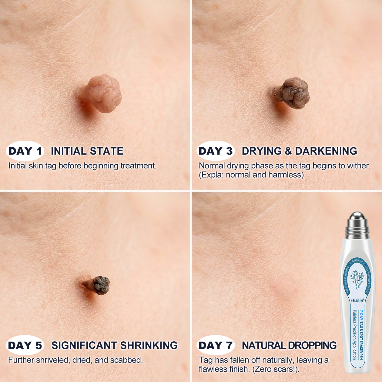 𝑯i𝒔𝒌𝒊n® 7-𝐷𝑎𝑦 𝗧𝐚𝐠 & 𝗦𝗽𝐨𝐭 𝐄𝐫𝒂𝒔𝒆𝒓✅🎉(Zero Pain, Zero 𝐒𝐜𝐚𝒓𝒔 Rollerball)