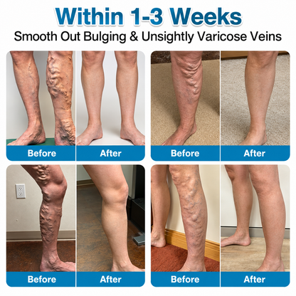 🇨🇦🏆✅️🏃𝗛𝗶𝘀𝗸𝗶𝗻® VeinRepair Microneedle Patch Roll⚡Instant Relief, Long-Term Results