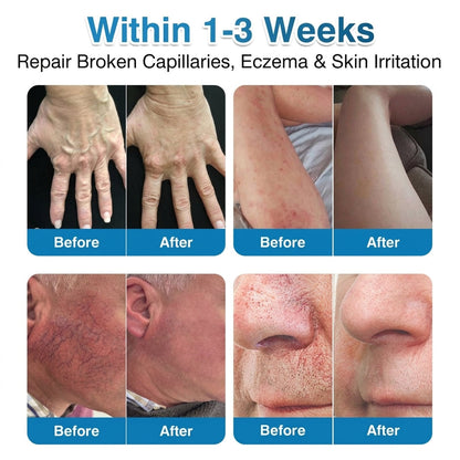 🇨🇦🏆✅️🏃𝗛𝗶𝘀𝗸𝗶𝗻® VeinRepair Microneedle Patch Roll⚡Instant Relief, Long-Term Results